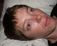 Akupunktur Migren Belirtileri ve Tedavisi